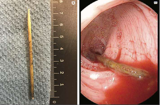 Illustration for article titled Esto es lo que pasa en el interior del cuerpo si te tragas un palillo de dientes y los médicos no lo encuentran durante tres semanas